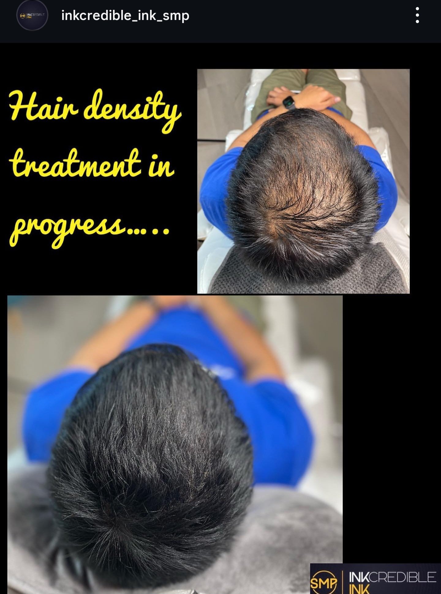 Hair Restoration Brisbane
